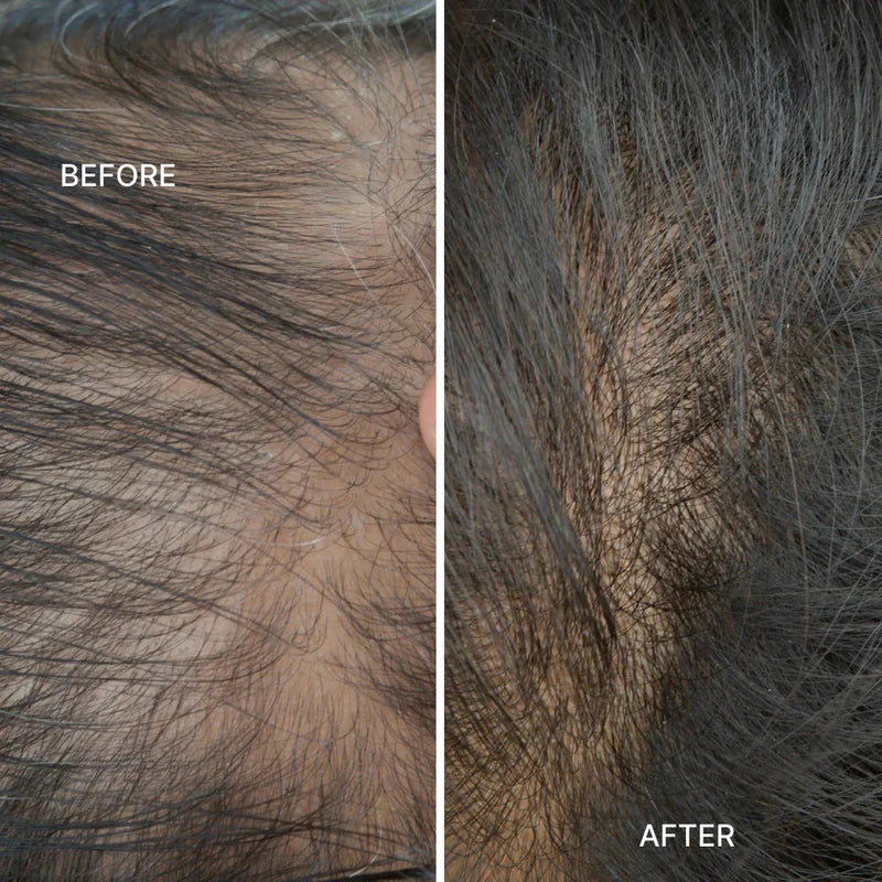 Red Light Therapy Scalp Massager 🔥 Limited Time Offer – Save 32% Today Only!