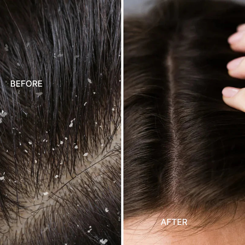 Red Light Therapy Scalp Massager 🔥 Limited Time Offer – Save 32% Today Only!